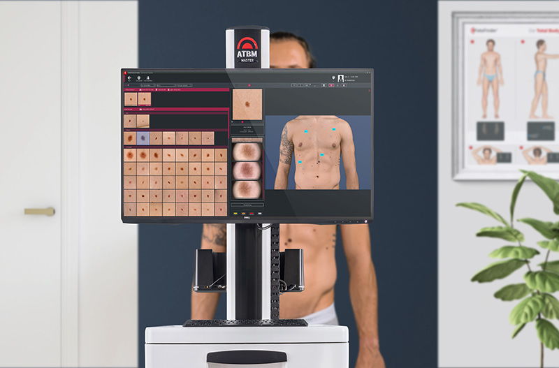 Hautkrebs-Früherkennung bei Hautarzt Dr. MAndl in SAlzburg Automatisches Total Body Mapping